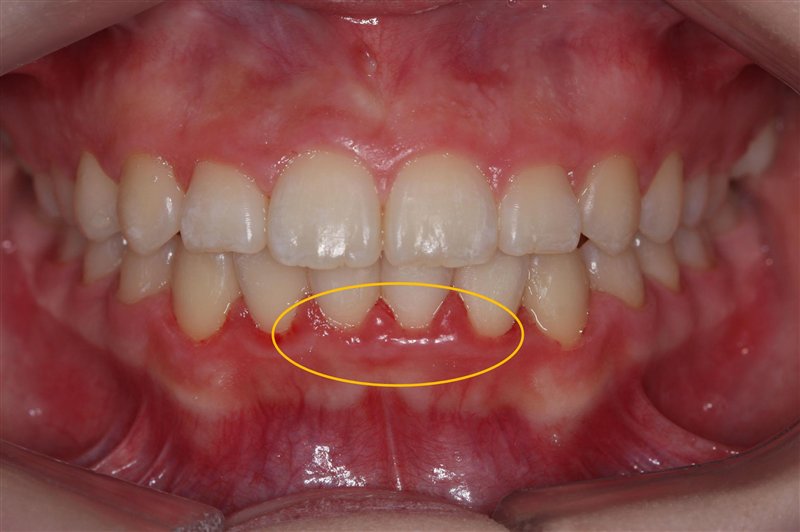 牙龈增生牙龈上长包